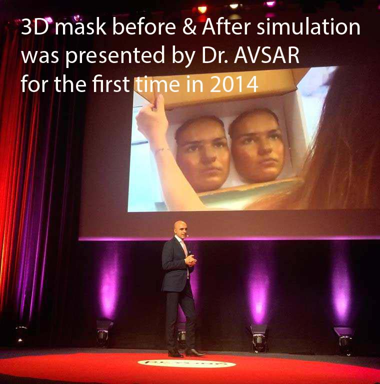 Burun Estetiğinde Yeni Yöntem 3D Avşar Maskesi